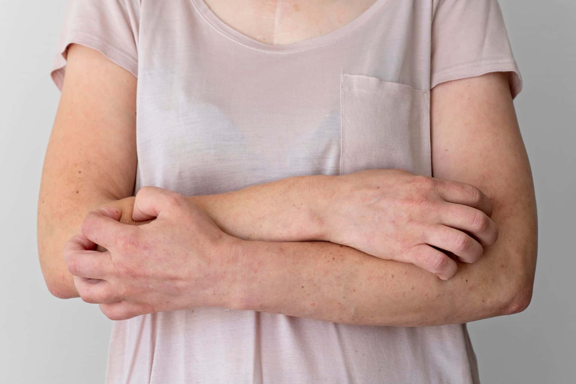 Esistono diversi modo per combattere la dermatite seborroica ma spesso sarà necessario rivolgersi al medico di fiducia
