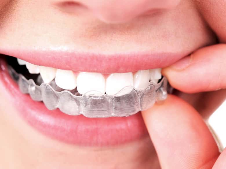 Invisalign Roma per risolvere il problema di denti storti