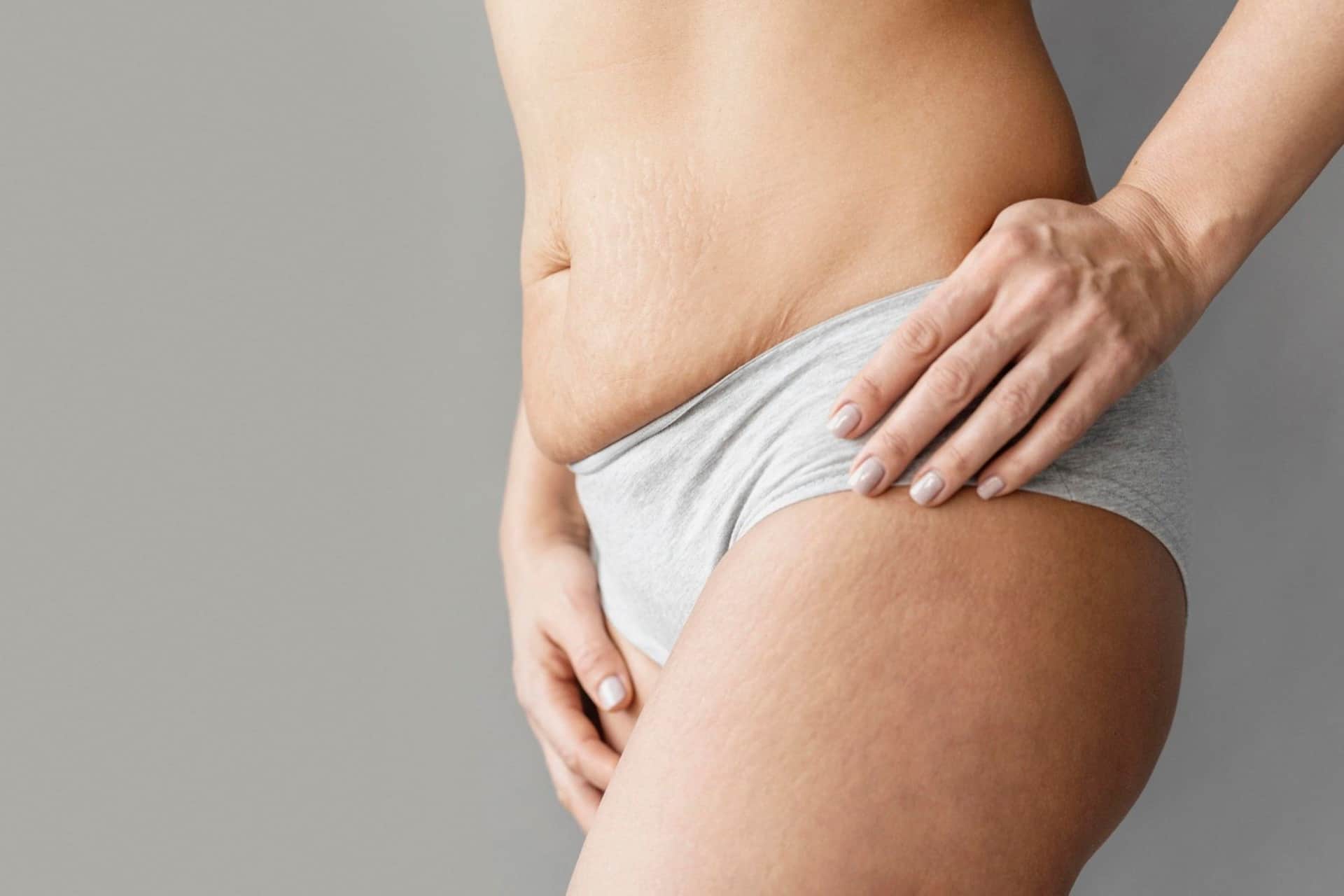 L'immagine mostra una pelle con smagliature su fianchi e cosce. Le smagliature possono verificarsi a causa di cambiamenti rapidi di peso, gravidanza, crescita durante l'adolescenza o squilibri ormonali.